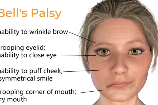 Bells Palsy