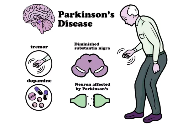 Parkinson’s Disease